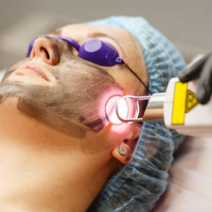 Laser Skin Resurfacing